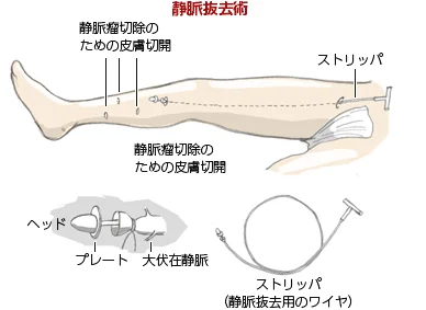 ストリッピング手術イメージ
