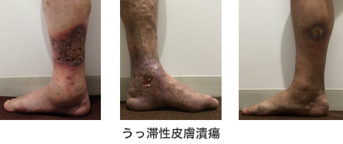 うっ滞性皮膚潰瘍
